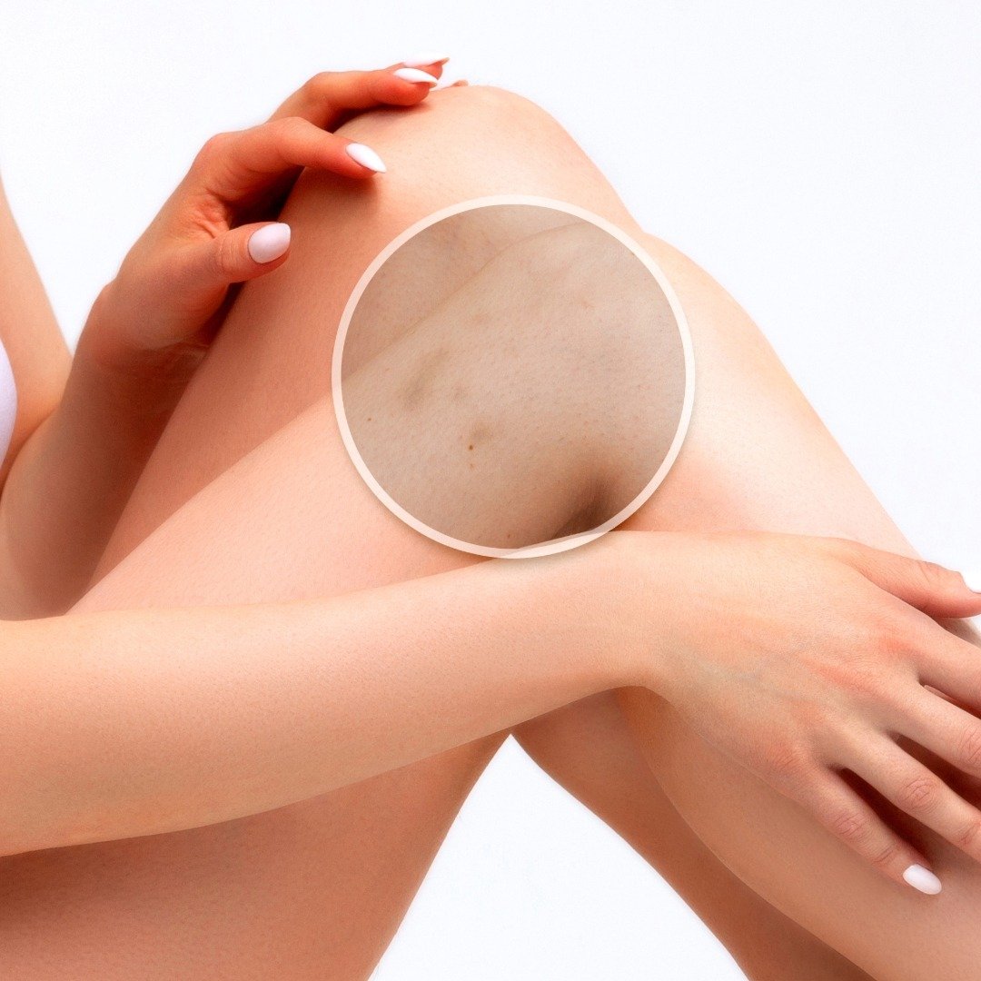 How to Avoid Bruising After a Body Wax 1 Preventing bruises during body waxing technique demo